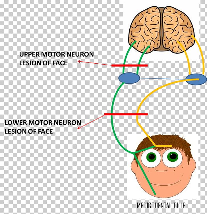 Lower Motor Neuron Lesion Facial Nerve Upper Motor Neuron Lesion PNG, Clipart, Area, Bells Palsy, Brain, Diagram, Disease Free PNG Download
