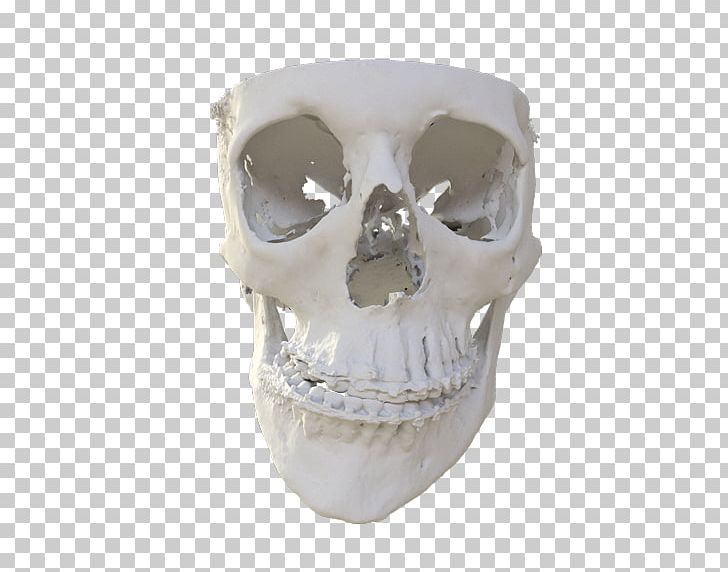 Skull MedCAD Surgery Skeleton Patient PNG, Clipart, 3d Computer Graphics, 3d Modeling, Bone, Clinic, Fantasy Free PNG Download
