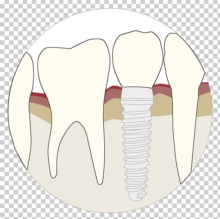 Tooth Velopex International Dentistry Dental Implant Dental Abrasion PNG, Clipart, Airpolishing, Anesthesia, Augmentation, Bone, Dental Abrasion Free PNG Download