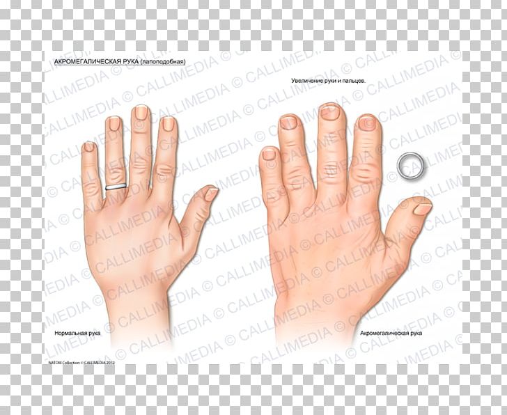 Acromegaly Nail Hand Endocrinology Thumb PNG, Clipart, Acromegaly, Arm, Digit, Disease, Endocrinology Free PNG Download