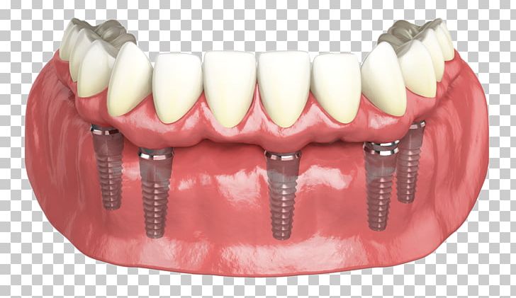 Hybridge Dental Implants Dentistry PNG, Clipart, Cosmetic Dentistry, Crown, Dental Implant, Dental Implants, Dental Restoration Free PNG Download