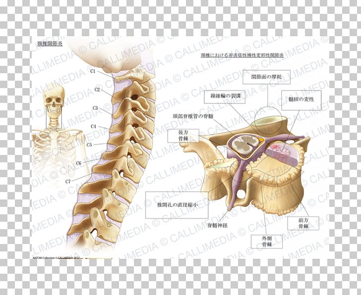 Cervical Osteoarthritis Cervical Vertebrae Pain PNG, Clipart, Angle ...