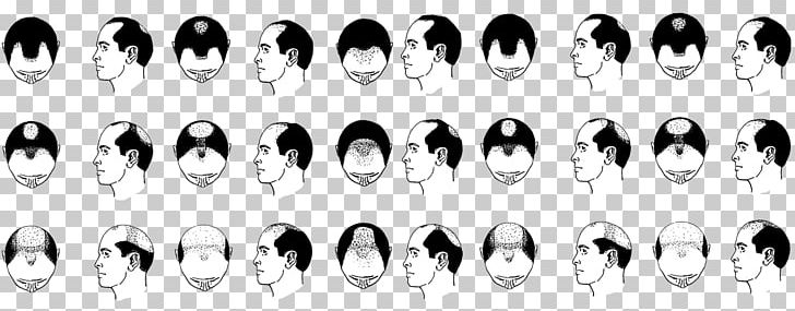 Pattern Hair Loss Hair Transplantation Management Of Hair Loss Hair Follicle PNG, Clipart, Black And White, Dihydrotestosterone, Fashion Accessory, Hair, Hair Follicle Free PNG Download