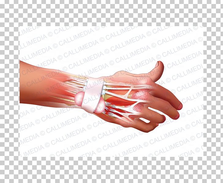 Hand Model Nail Rheumatoid Arthritis Disease PNG, Clipart, Arm, Disease, Finger, Hand, Hand Model Free PNG Download
