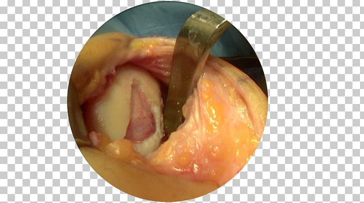 Arthrotomy Microfracture Surgery Arthroscopy Articular Cartilage
