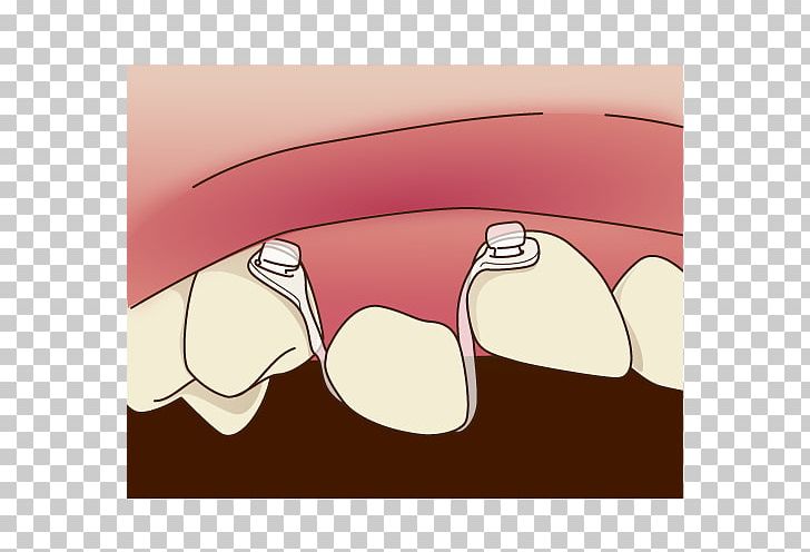 Tooth Dentist 矯正歯科 Dental Braces PNG, Clipart, Closeup, Computer Wallpaper, Dental Braces, Dentist, Dentition Free PNG Download