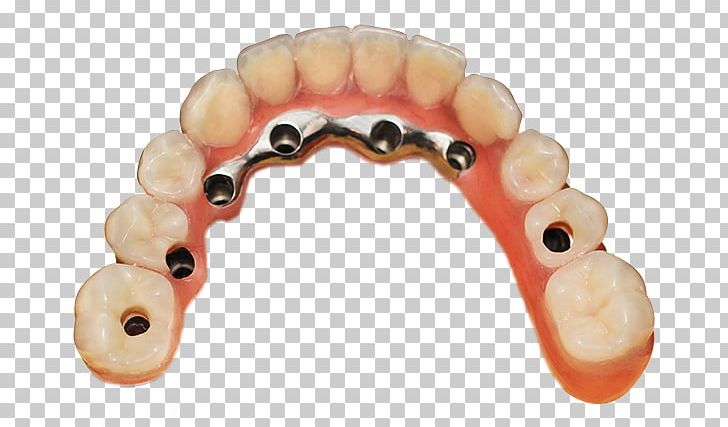 Tooth Dentures Crown Bridge Implantology PNG, Clipart, Bridge, Cobaltchrome, Crown, Dental Implant, Dentures Free PNG Download