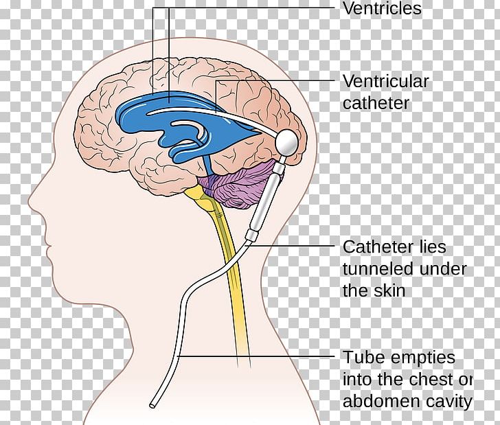 Cerebral Shunt Neurosurgery Hydrocephalus Cerebrospinal Fluid PNG, Clipart, Angle, Area, Brain, Cerebral Shunt, Cerebrospinal Fluid Free PNG Download