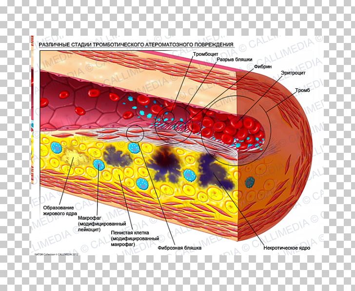 Atheroma Atherosclerosis Artery Stenosis Disease PNG, Clipart, Artery, Atheroma, Atherosclerosis, Cardiology, Carotid Artery Stenosis Free PNG Download