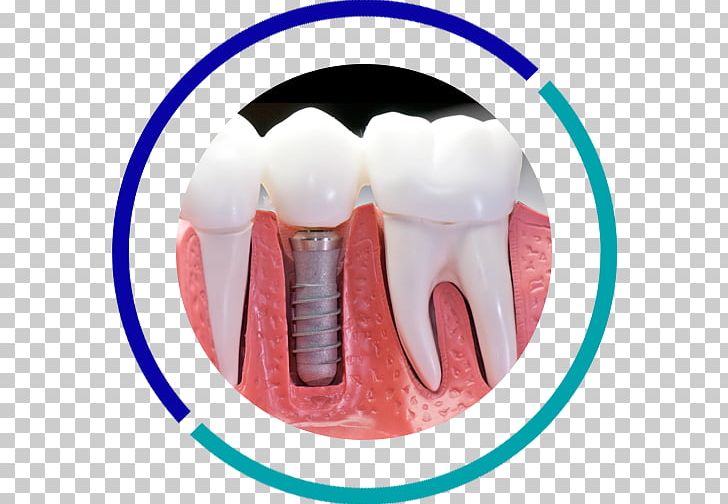 Dental Implant Dentistry Tooth PNG, Clipart, Abutment, Biocompatibility, Bridge, Crown, Dental Implant Free PNG Download