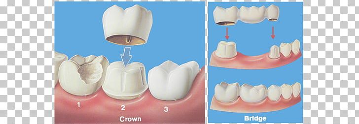 Bridge Crown Dentistry Dental Restoration PNG, Clipart, Bridge, Cosmetic Dentistry, Cracked Tooth Syndrome, Crown, Dental Free PNG Download