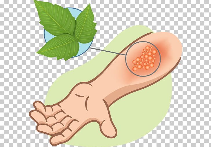 Poison Ivy Western Poison Oak Skin Rash Itch Tecnu PNG, Clipart, Allergy, Blister, Dermatology, Finger, Foot Free PNG Download