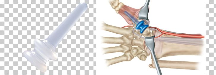 Finger Interphalangeal Joints Of The Hand Interphalangeal Joints Of The Hand Implant PNG, Clipart, Arm, Arthrodesis, Ear, Empresa, Finger Free PNG Download