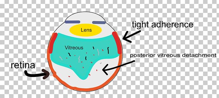 Posterior Vitreous Detachment Floater Vitreous Body Retina Photopsia PNG, Clipart, Area, Brand, Diagram, Eye, Floater Free PNG Download