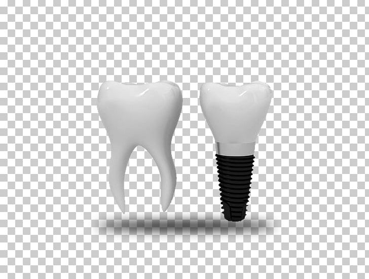 Tooth Dental Implant Dentistry Orthodontics PNG, Clipart, 2018, Dental Consonant, Dental Implant, Dentistry, Human Tooth Free PNG Download