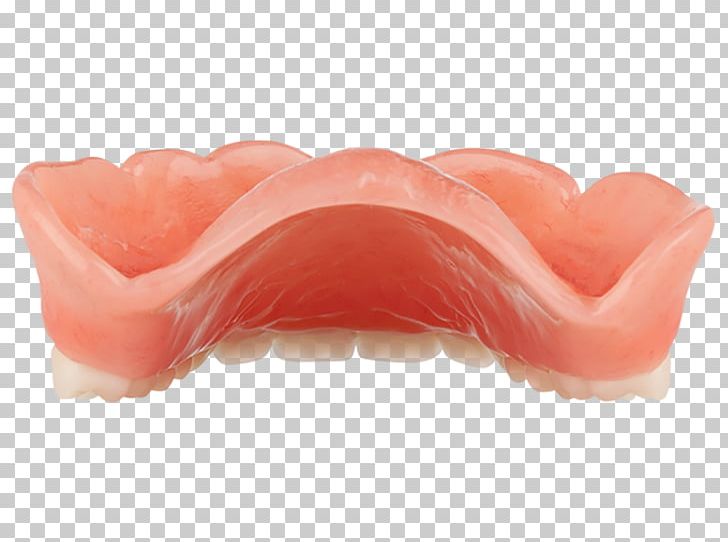 Mouth Dentures PNG, Clipart, Aspen, Dental, Dentures, Heat, Inject Free PNG Download