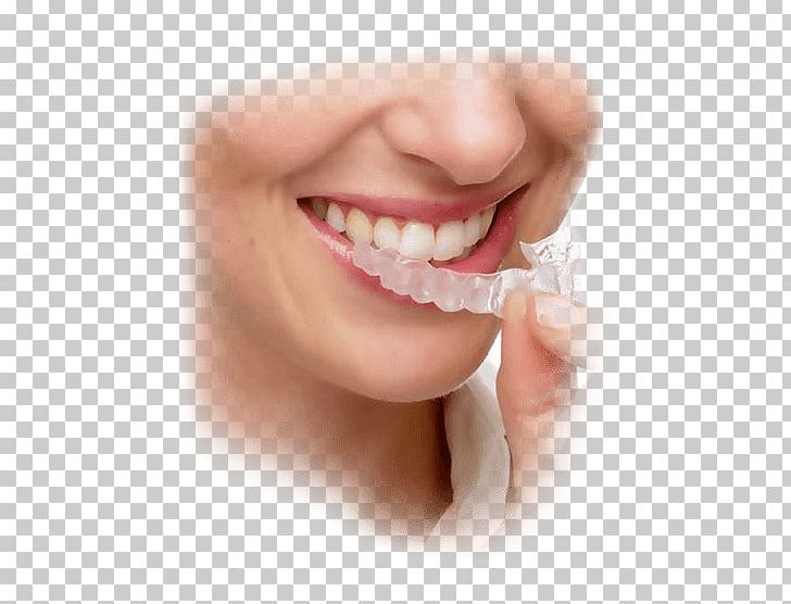 Clear Aligners Orthodontics Dental Braces Dentistry PNG, Clipart, Cheek, Chin, Clear Aligners, Clearcorrect, Closeup Free PNG Download