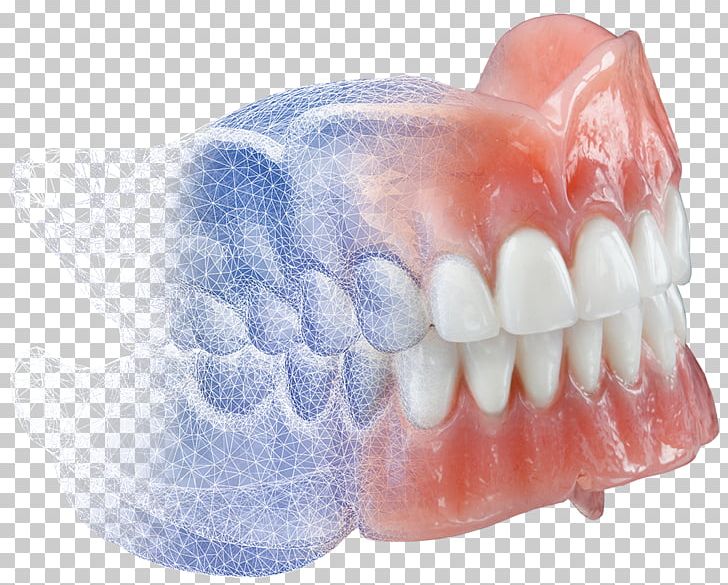 Dentures Burdette Dental Lab CAD/CAM Dentistry PNG, Clipart, 3d Dental Treatment For Toothache, Burdette Dental Lab, Cadcam Dentistry, Computer, Cone Beam Computed Tomography Free PNG Download