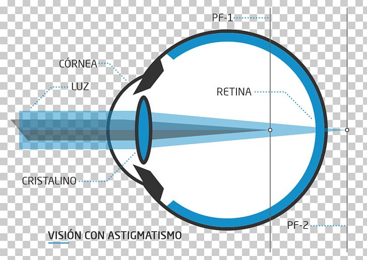 Floater Nd:YAG Laser Visual Perception Presbyopia Eye PNG, Clipart, Angle, Circle, Diagram, Eye, Eye Surgery Free PNG Download