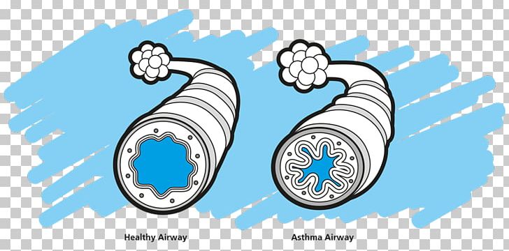 Asthma Spacer Nursing Care Plan Disease PNG, Clipart,  Free PNG Download