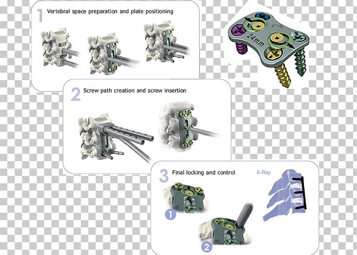 Arthrodesis Cervical Vertebrae Information Joint PNG, Clipart, Anatomy, Arthrodesis, Cervical Vertebrae, Esophagus, Information Free PNG Download