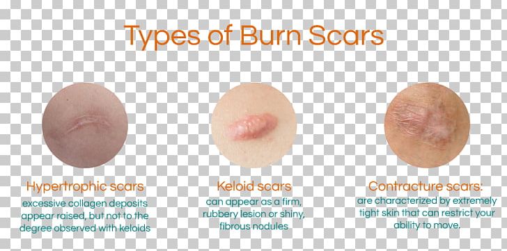 Burn Scar Contracture Hypertrophic Scar Keloid PNG, Clipart, Acne, Aloe Vera, Burn, Burn Scar, Burn Scar Contracture Free PNG Download