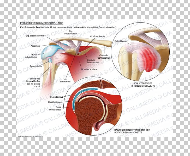 Adhesive Capsulitis Of Shoulder Periartrite Scapolo-omerale Rheumatology Shoulder Joint PNG, Clipart, Ache, Adhesive Capsulitis Of Shoulder, Arthritis, Biceps, Calcific Tendinitis Free PNG Download