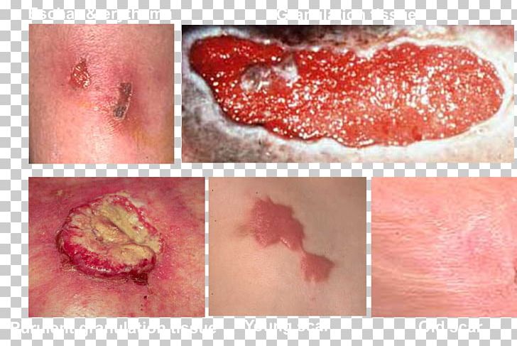 Maggot Therapy Skin Close-up PNG, Clipart, Closeup, Disease, Finger, Flesh, Jaw Free PNG Download