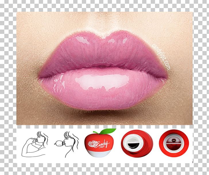 Lip Augmentation Cosmetics Face Restylane PNG, Clipart, Cosmetics, Eyelash, Face, Gel, Injection Free PNG Download