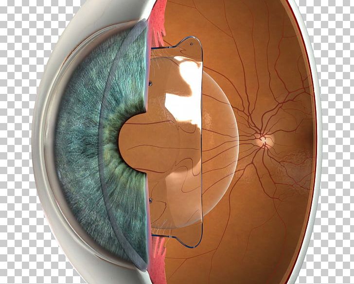 Phakic Intraocular Lens Implantable Collamer Lens LASIK Visual Perception PNG, Clipart, Contact Lenses, Corrective Lens, Eye, Implant, Implantable Collamer Lens Free PNG Download