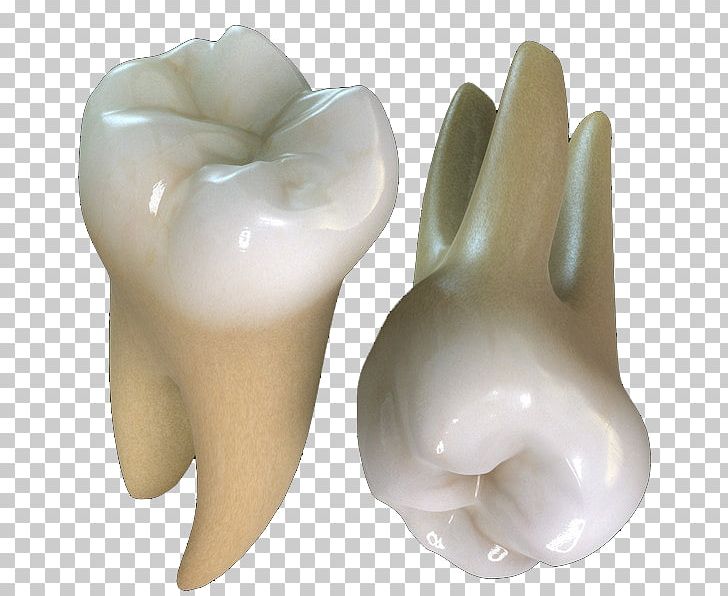Human Tooth Maxillary First Molar Tooth Decay PNG, Clipart, Crown, Dental Extraction, Dental Restoration, Dentist, Dentistry Free PNG Download