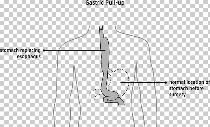 Thumb Surgery /m/02csf Esophageal Cancer Esophagus PNG, Clipart, Abdomen, Angle, Arm, Black And White, Bone Free PNG Download