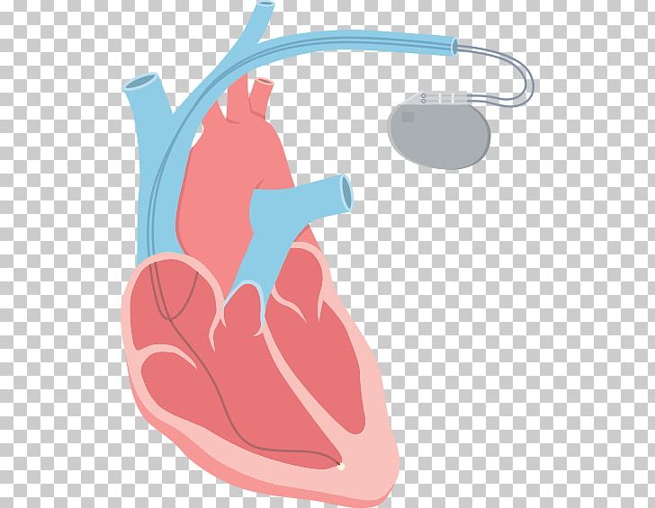 Heart Arrhythmia Tachycardia Catheter Ablation PNG, Clipart, Catheter Ablation, Defibrillation, Hand, Heart, Heart Arrhythmia Free PNG Download