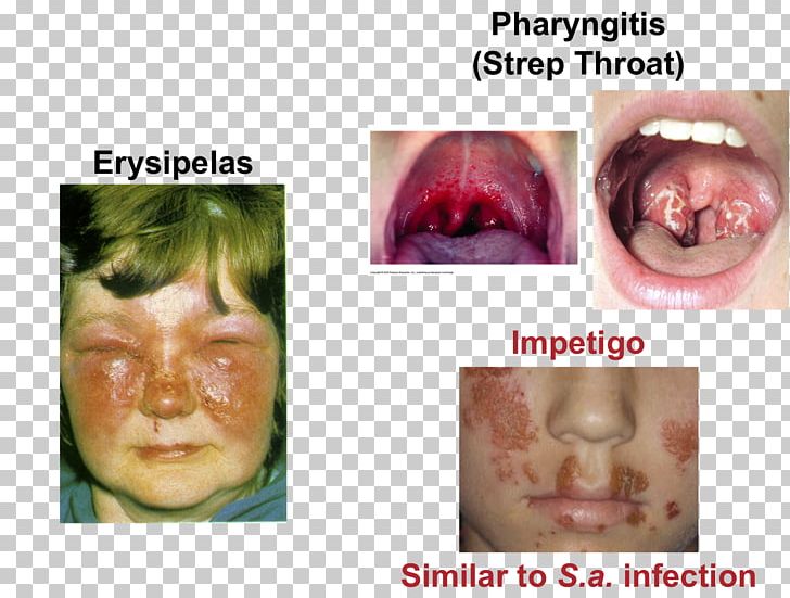 Lip Cheek Streptococcal Pharyngitis Chin Tonsillitis PNG, Clipart, Cheek, Chin, Closeup, Closeup, Disease Free PNG Download