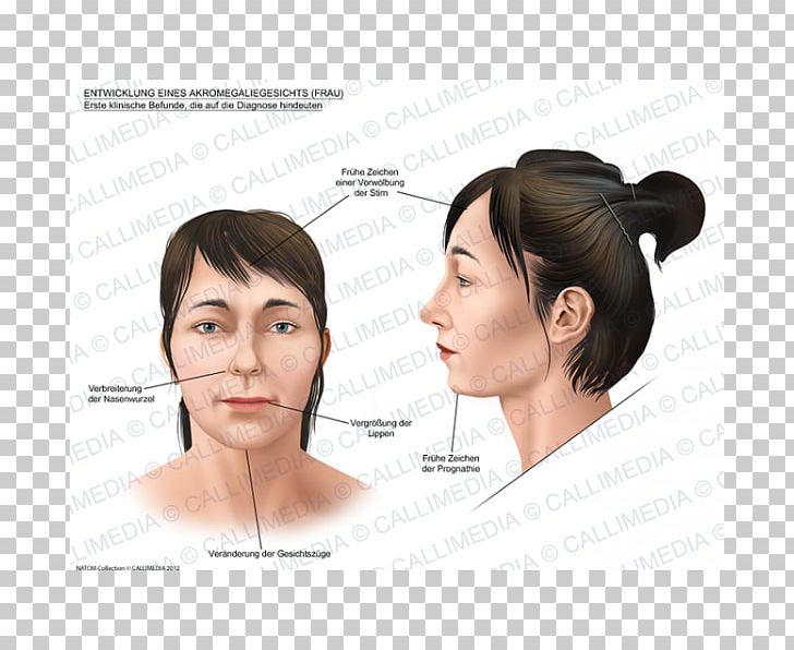 Acromegaly Face Skull Bossing Gigantism Symptom PNG, Clipart, Acromegaly, Cheek, Chin, Ear, Endocrinology Free PNG Download