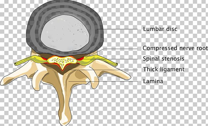Spinal Disc Herniation Spinal Cord Spinal Stenosis Back Pain PNG, Clipart,  Free PNG Download