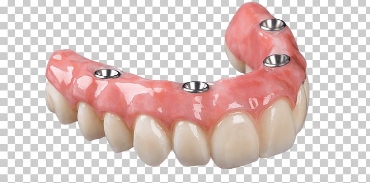 Dental Implant Dentures Removable Partial Denture Dental Prosthesis Dentistry PNG, Clipart, Abutment, Allon4, Bridge, Dental, Dental Implant Free PNG Download