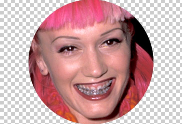 Gwen Stefani Singer-songwriter Celebrity Dental Braces Plastic Surgery PNG, Clipart, Actor, Brown Hair, Celebrity, Cheek, Chin Free PNG Download