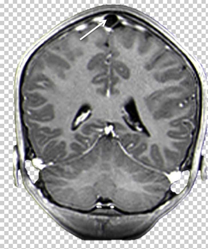 Brain Arachnoid Granulation Superior Sagittal Sinus Magnetic Resonance Imaging Arachnoid Mater PNG, Clipart, Arachnoid Granulation, Arrow, Brain, Contrast, Coronal Plane Free PNG Download