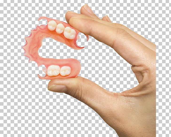 Removable Partial Denture Dentures Dentistry Prosthodontics PNG, Clipart, Bridge, Crown, Dental Hygienist, Dental Implant, Dental Laboratory Free PNG Download