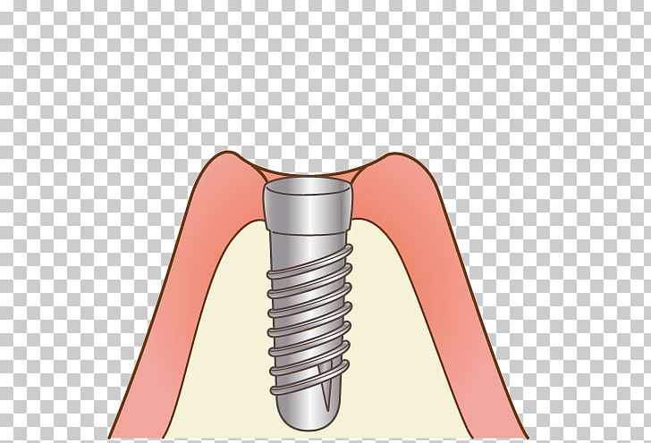 審美歯科 Dentist 矯正歯科 けやき歯科クリニック PNG, Clipart, Angle, Dental Implant, Dentist, Dentures, Hardware Free PNG Download