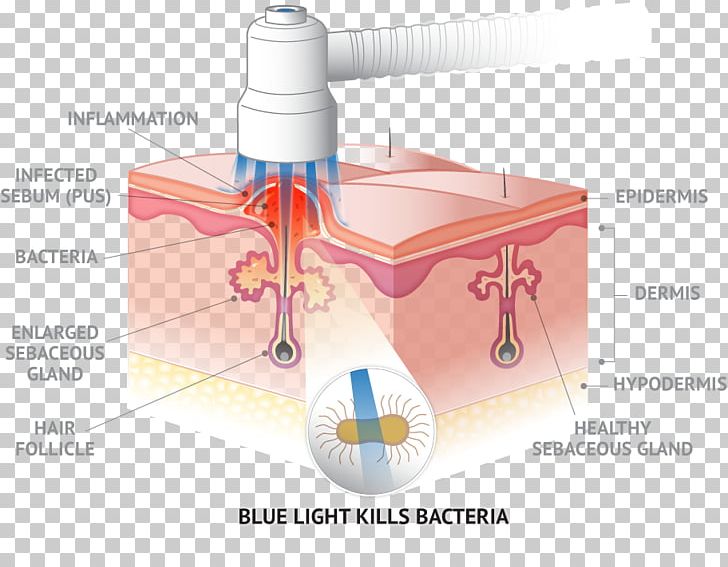 Propionibacterium Acnes Light Therapy Skin PNG, Clipart, Acne, Angle, Bacteria, Blue, Dermatology Free PNG Download