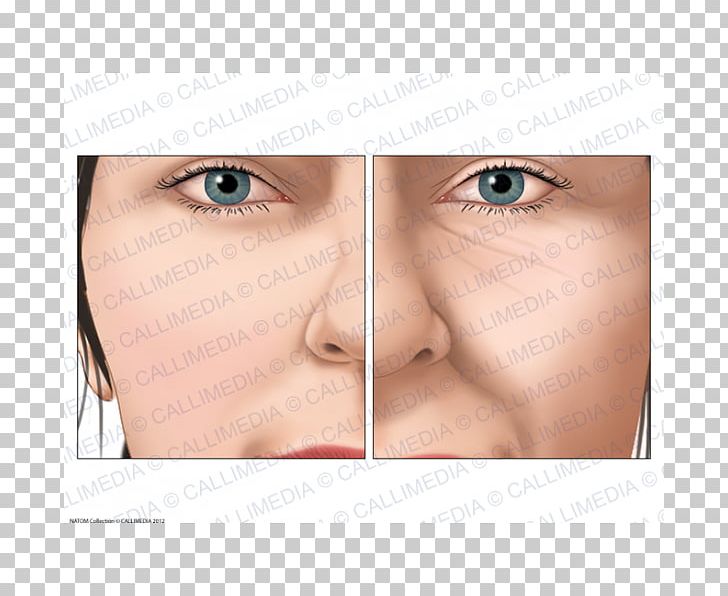 Acromegaly Nose Face Endocrinology Cheek PNG, Clipart, Acromegaly, Blood Sugar, Cheek, Chin, Closeup Free PNG Download