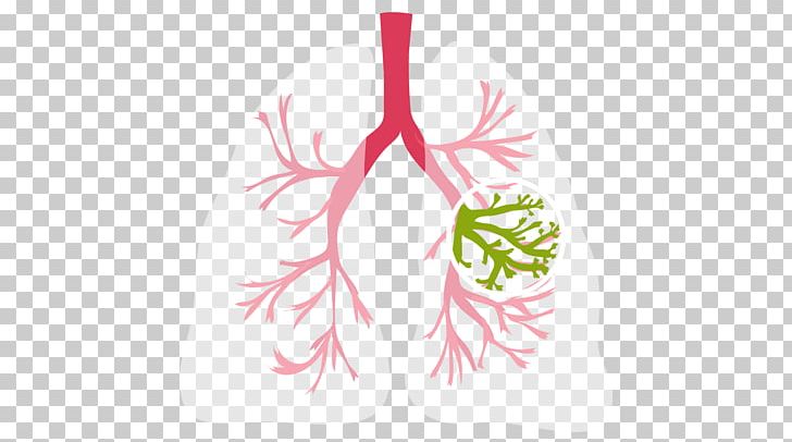 Cystic Fibrosis Lung Medical Diagnosis Symptom Solitary Pulmonary Nodule PNG, Clipart, Atelectasis, Branch, Cystic Fibrosis, Flower, Flowering Plant Free PNG Download