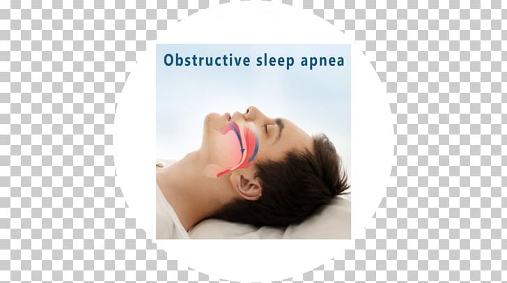 Obstructive Sleep Apnea In Adults PNG, Clipart, Apnea, Brand, Chin, Dentistry, Ear Free PNG Download