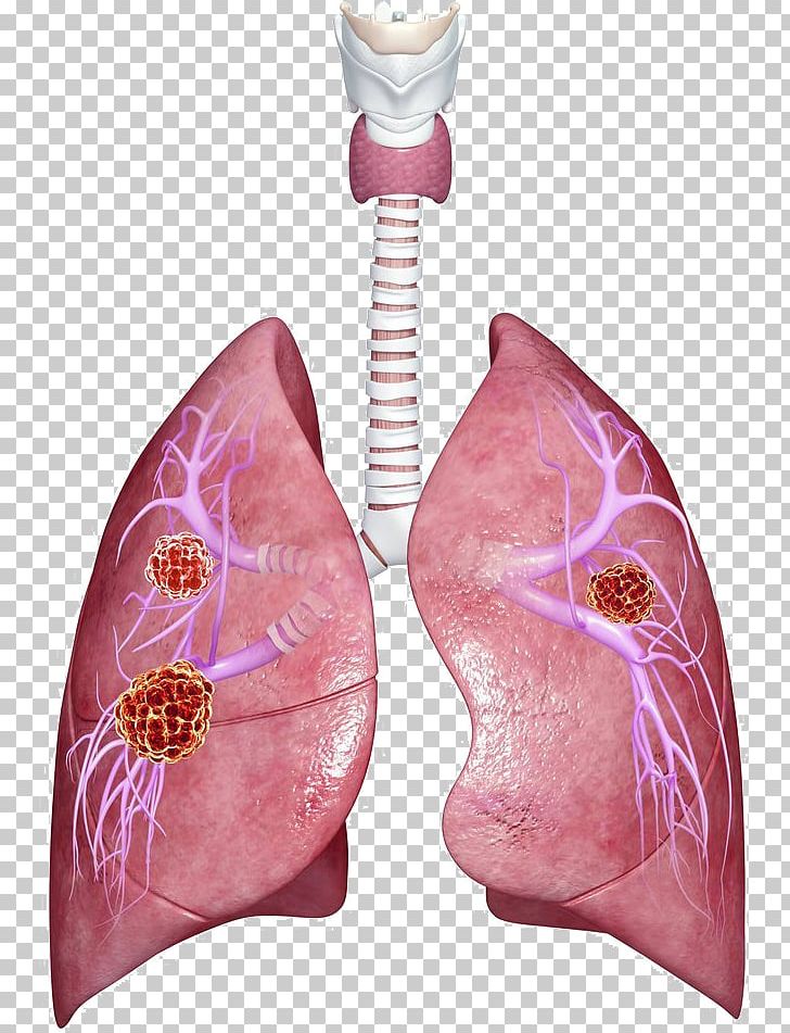 Metastasis Lung Cancer Lung Cancer Organ PNG, Clipart, Cancer, Carcinoma, Cell, Disease, Liver Free PNG Download