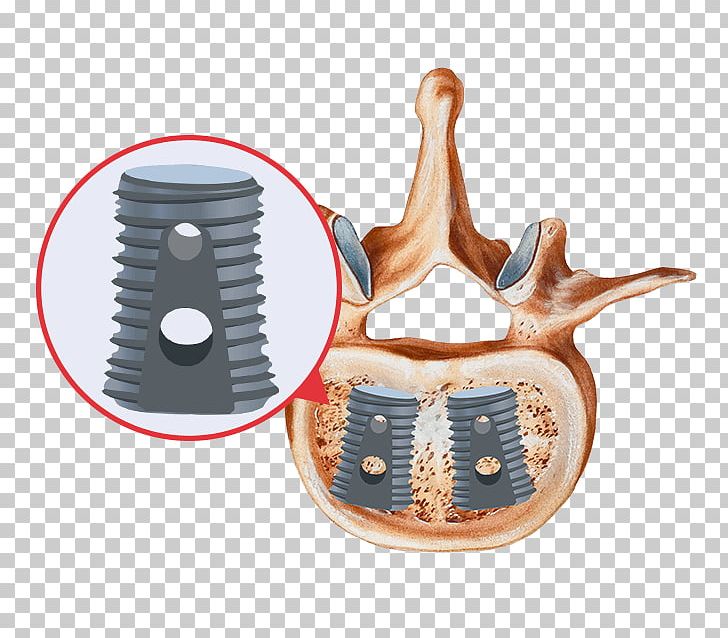 Bone Grafting Spinal Fusion Bone Morphogenetic Protein Implant PNG, Clipart, Bone, Bone Grafting, Bone Morphogenetic Protein, Cervical, Cervical Vertebrae Free PNG Download