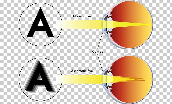 Astigmatism Near-sightedness Eye Far-sightedness Visual Perception PNG, Clipart, Angle, Astigmatism, Brand, Circle, Contact Lenses Free PNG Download