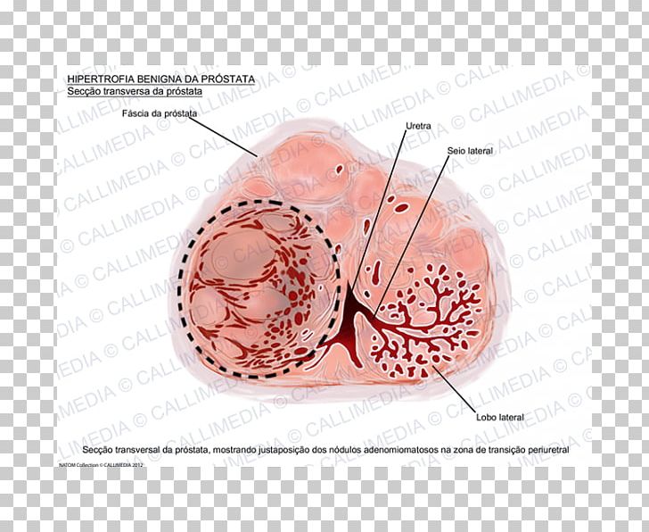 Prostate Benign Prostatic Hyperplasia Urology Excretory System Hypertrophy PNG, Clipart, Benignity, Benign Prostatic Hyperplasia, Benign Tumor, Catheter, Cross Section Free PNG Download