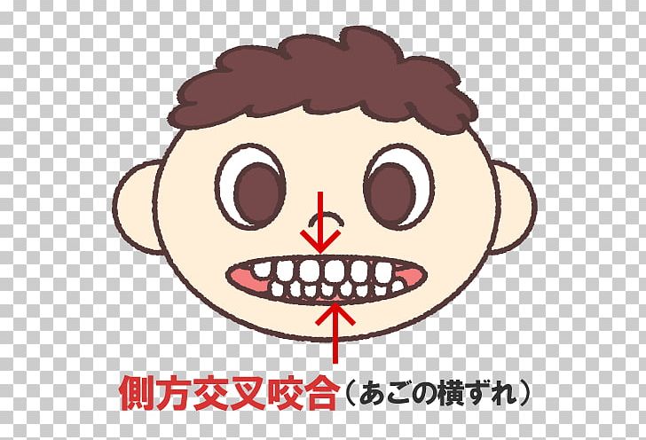 矯正歯科 Dentistry Prognathism PNG, Clipart, Area, Cheek, Clinic, Crossbite, Dental Braces Free PNG Download